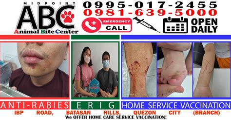 rac animal bite clinic - batasan|Animal Bite Center .